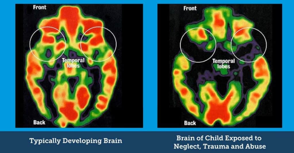 Images of brain scans comparing a typical brain to one exposed to neglect and trauma